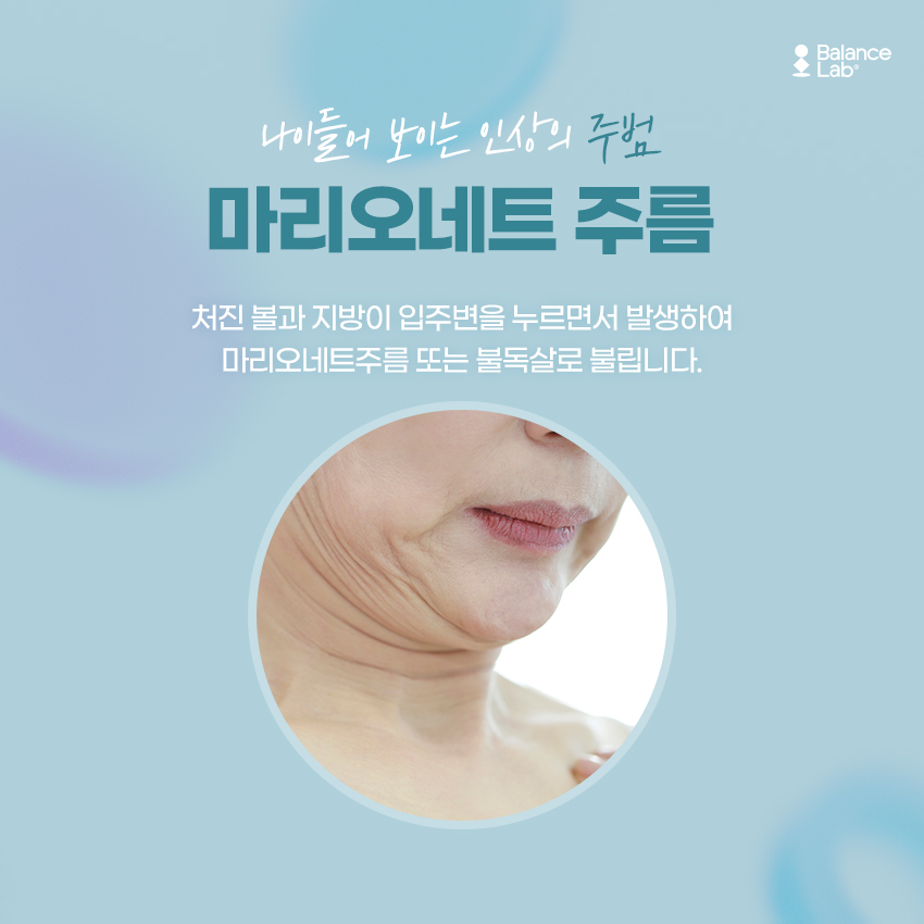 Is Marionette Filler Effective for Removing Lines Around the Mouth and Nasolabial Folds? image 2