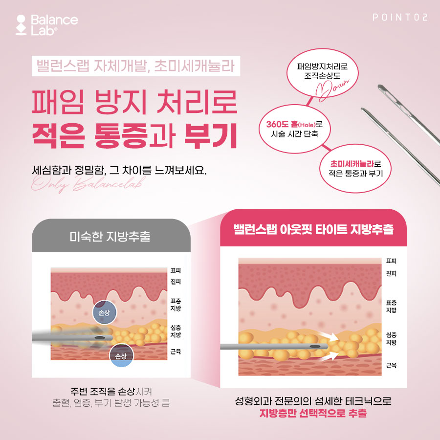 팔지방흡입후기, 나도 뼈팔이 가능할까? 관련 이미지 4