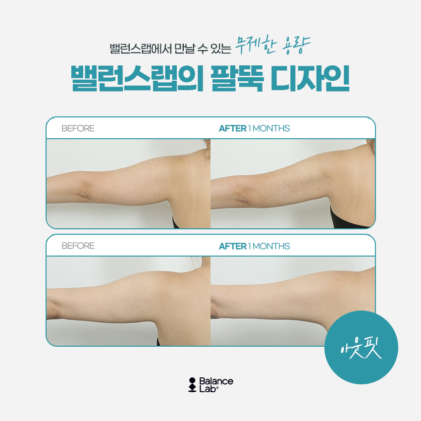 Honest Review of Arm Liposuction Recommendation: Until Seeing the Effects of Fat Extraction Injections image 4