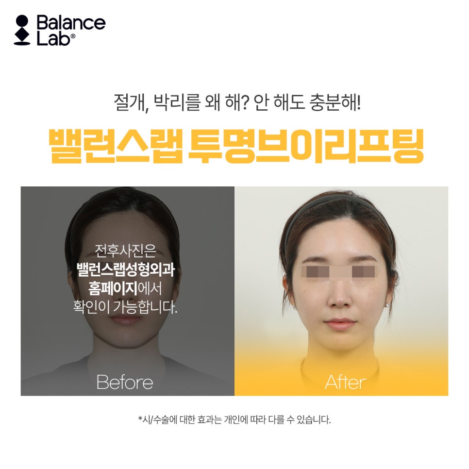 Highly Rated Thread Lifting: Balance Lab Transparent V Lifting image 6