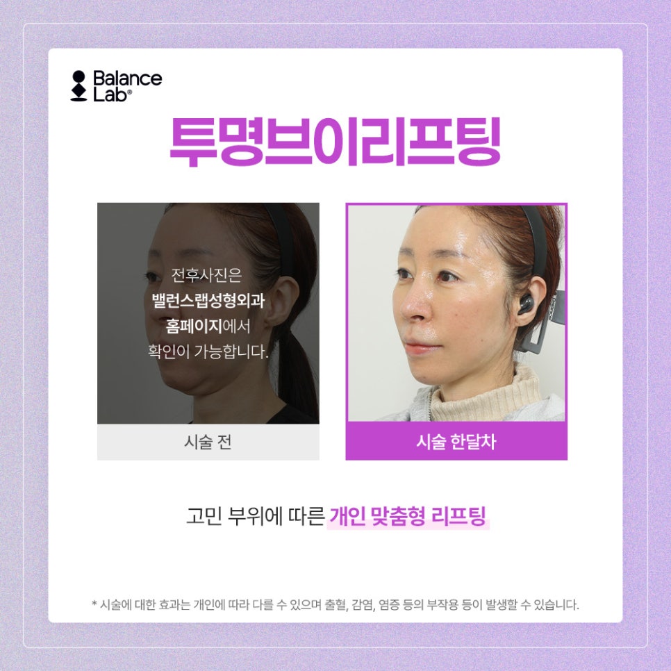 Can Midface Lifting Reduce the Appearance of a Long Midface at Balance Lab? image 6