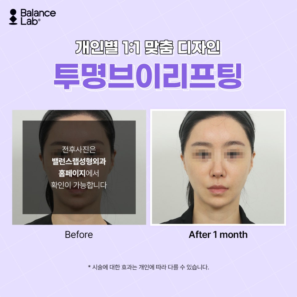 신사역 실 리프팅 오래 유지하고 싶다면 PCL로 해보세요 관련 이미지 6