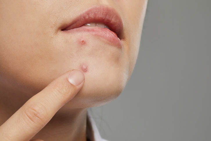 Types of Acne Scars, and How Can You Improve Scars? image 3