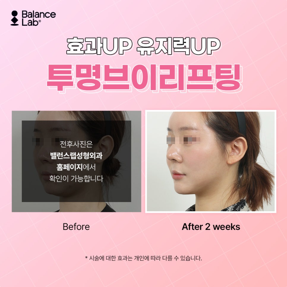 신사 투명브이리프팅 가격, 통증, 붓기 등 (실리프팅) 관련 이미지 5