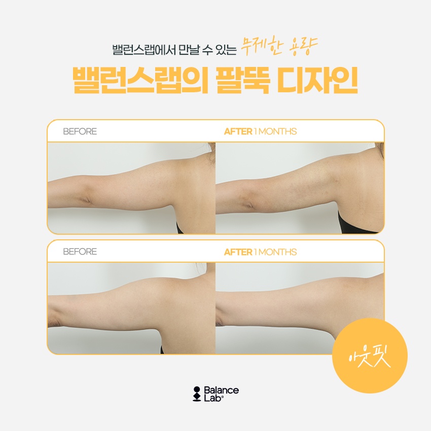 팔뚝지방흡입효과와 뼈팔만드는법 궁금하다면 관련 이미지 4