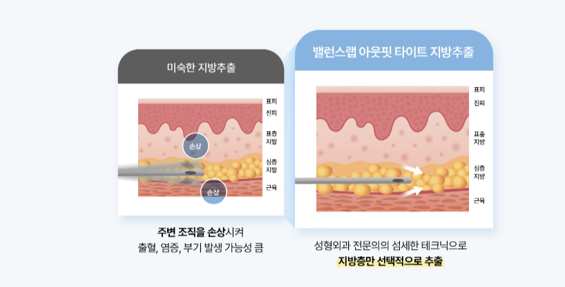 슬림한허리라인 복부지방추출주사로 가능하다면 관련 이미지 5