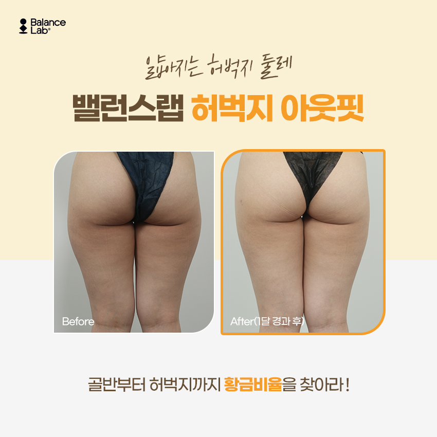 건강하게 승마살빼기 세가지 방법 허벅지 미니지방흡입 그리고? 관련 이미지 3
