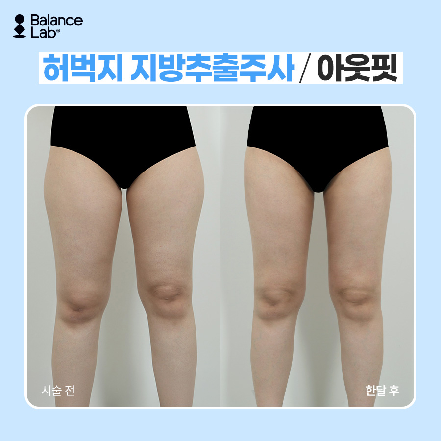 끝까지 안 빠지는 승마살, 허벅지지방추출주사로 허벅지살빼는법 관련 이미지 6