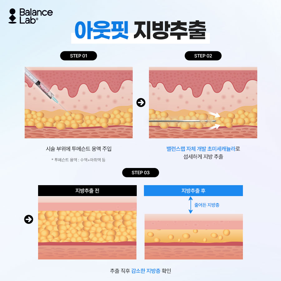 팔뚝지방추출주사, 멍·부기는 언제까지 갈까? 이장원 원장이 답하는 효과와 유지기간 관련 이미지 3