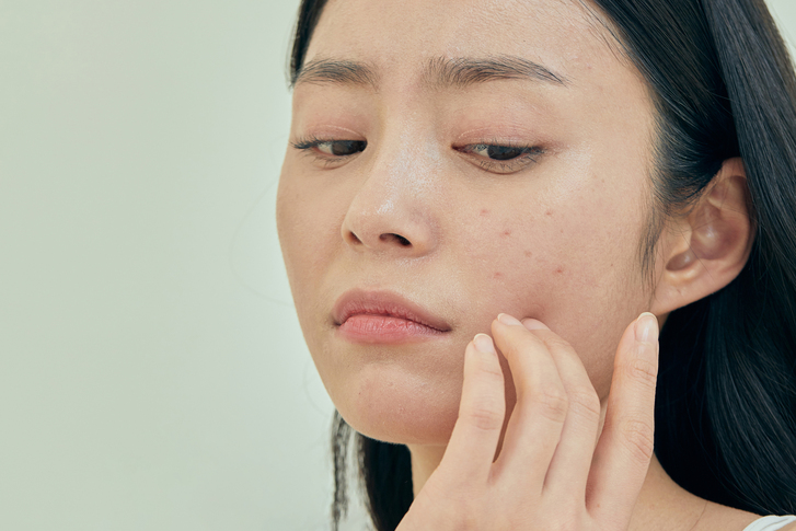 Types of Acne Scars, and How Can You Improve Scars? image 9