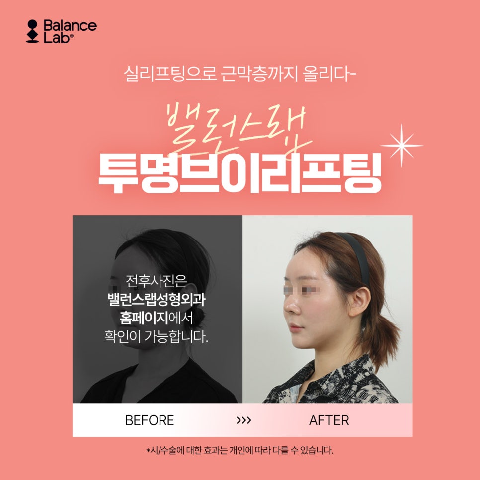 이중턱 리프팅 실로 당겨서 없앴어요, 밸런스랩에서💜 관련 이미지 5