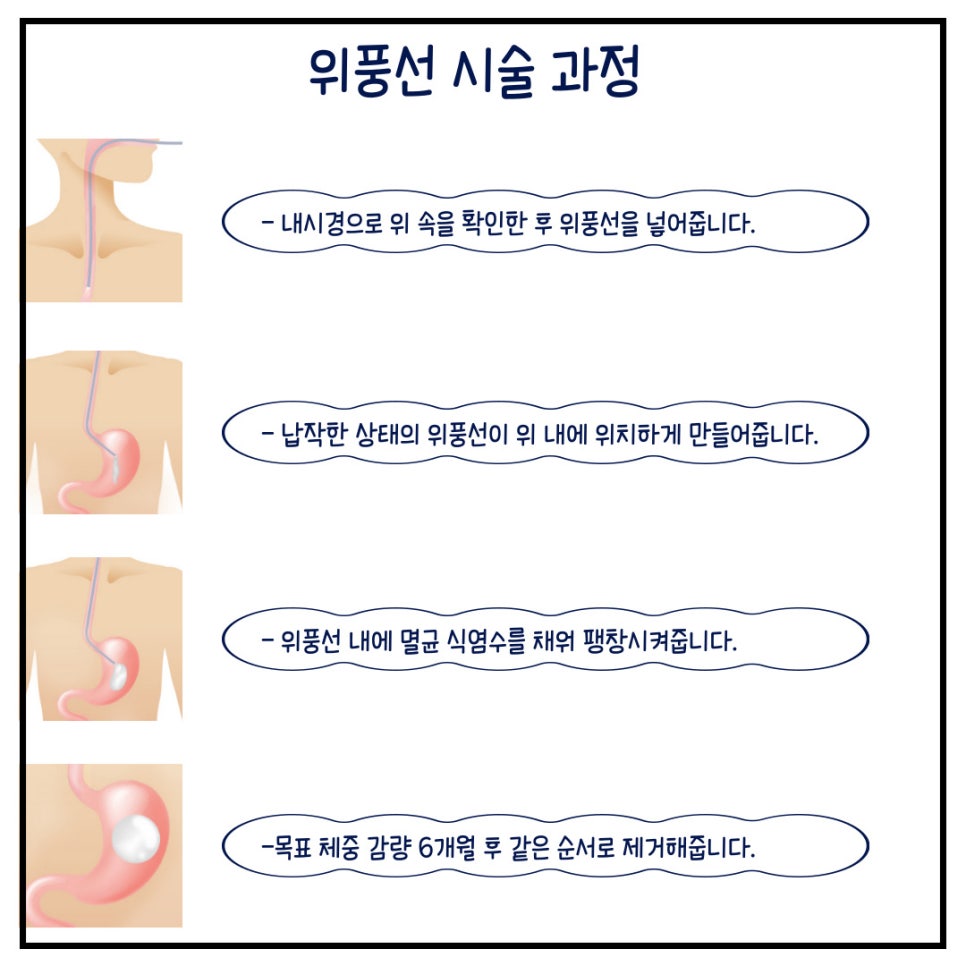 위풍선다이어트, 식이조절 해서 체중감량 했어요. 관련 이미지 5