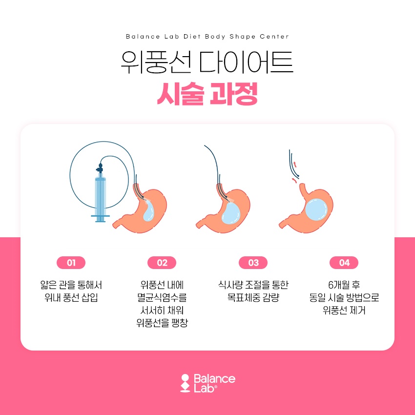 Healthy Diet BIB Balloon: If You Can’t Control Your Diet image 3