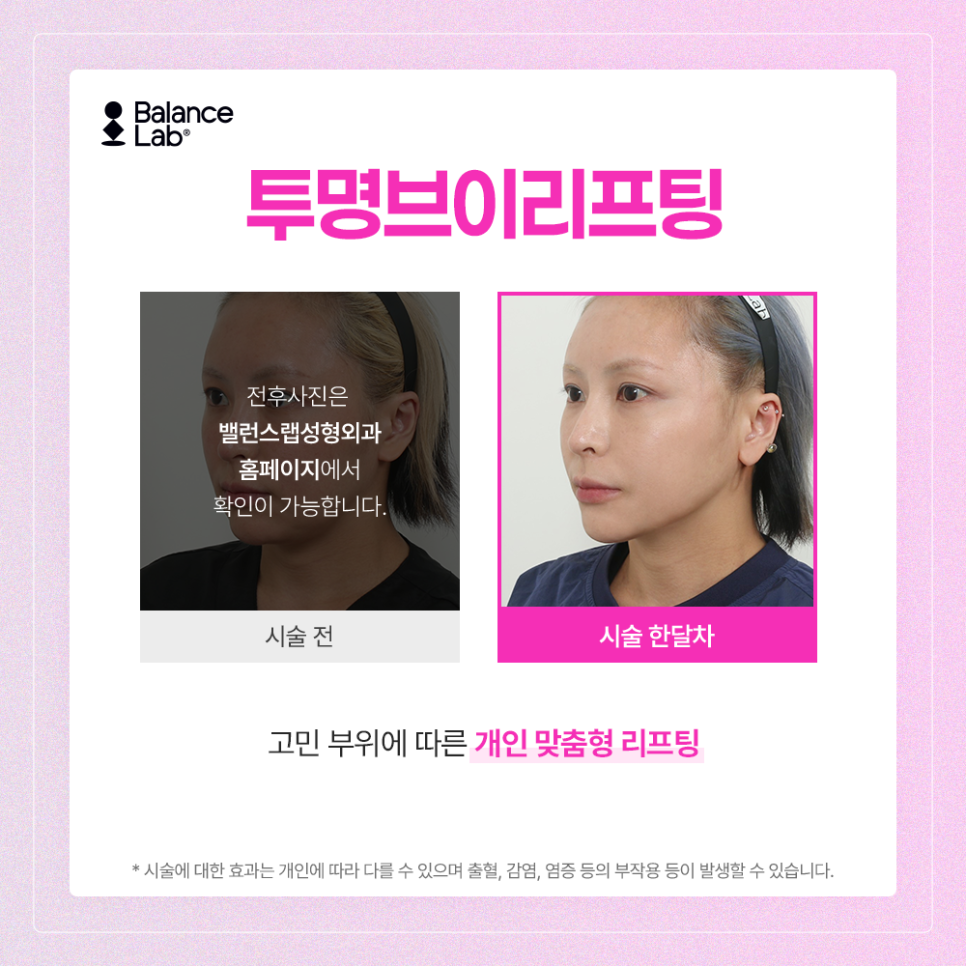 신사역성형외과 안면윤곽 볼 처짐은 투명브이리프팅이 답이다? 관련 이미지 3