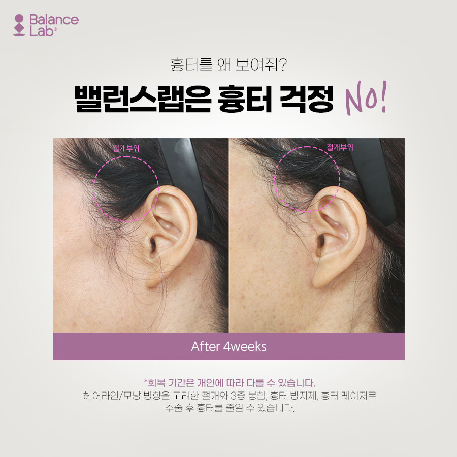 밸런스랩에서 받은 미니리프팅 후기가 좋을 수 있는 이유😋 관련 이미지 3