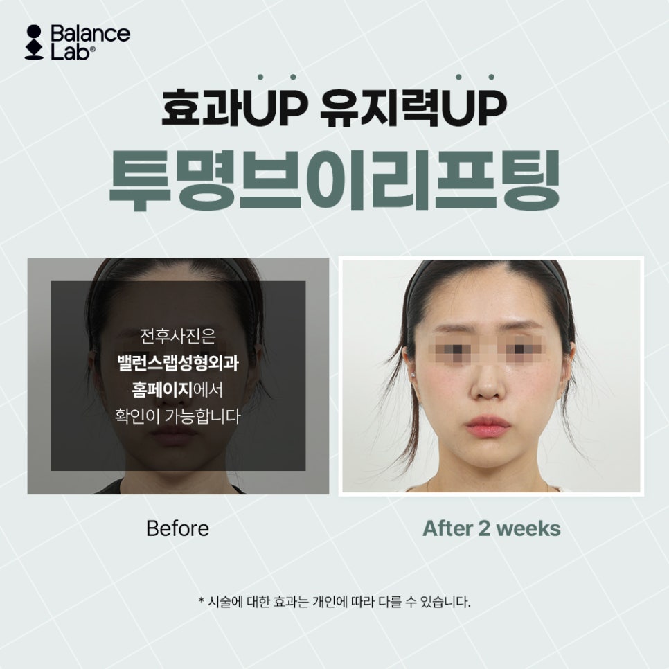 오래가는 라포엘 실 리프팅 효과 직접 체험해보니 관련 이미지 5