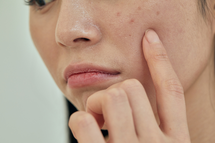 Types of Acne Scars, and How Can You Improve Scars? image 7