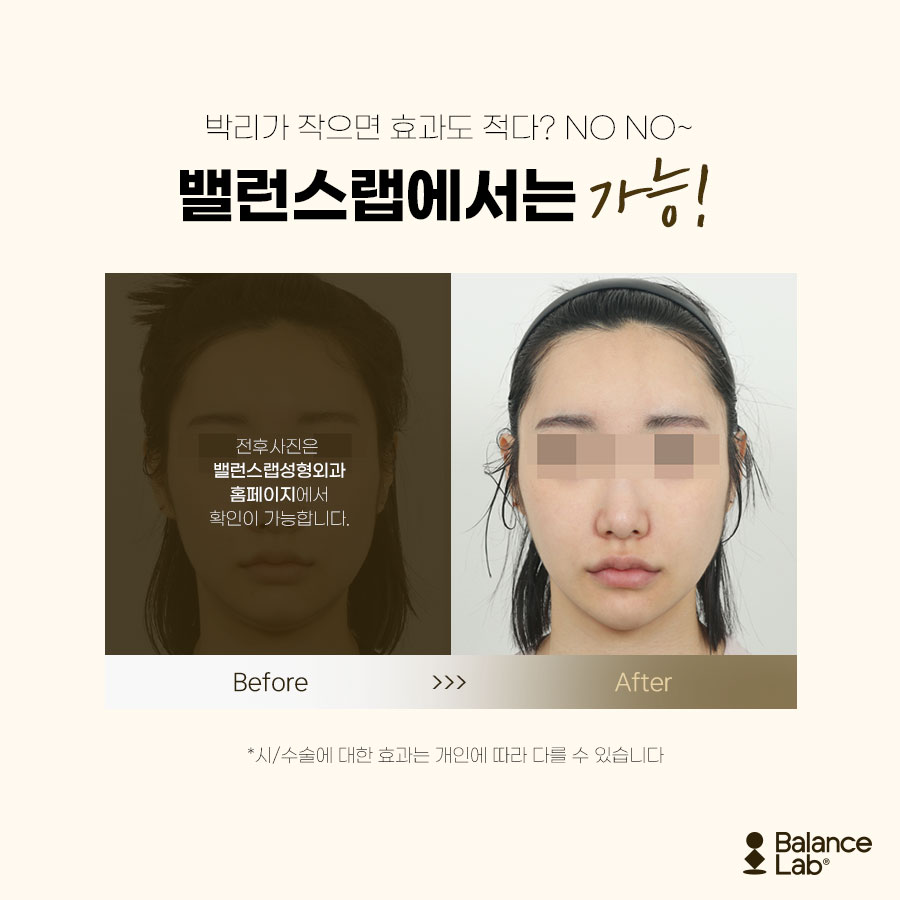 리프팅 흉터가 어떻게 투명해? 신사역 밸런스랩에서는 가능해!😁 관련 이미지 4