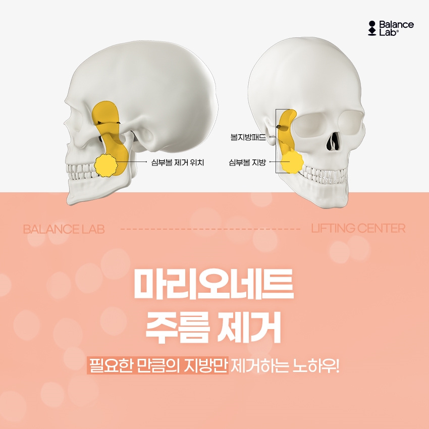 심부볼제거수술로 볼살빼기 하는방법은 관련 이미지 6