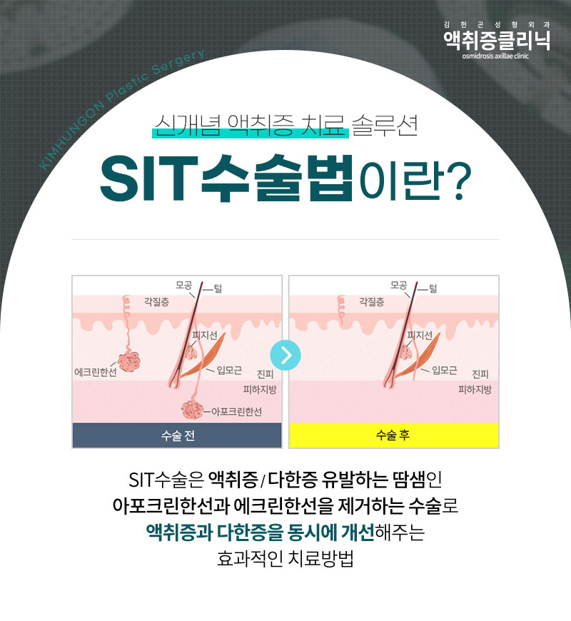 겨드랑이액취증 겨울철 한파에도 사라지지 않는 이유와 SIT수술 방법 관련 이미지 4