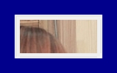 겨드랑이 냄새 제거 액취증 원인 SIT수술로 재발 걱정없는 치료 관련 이미지 19