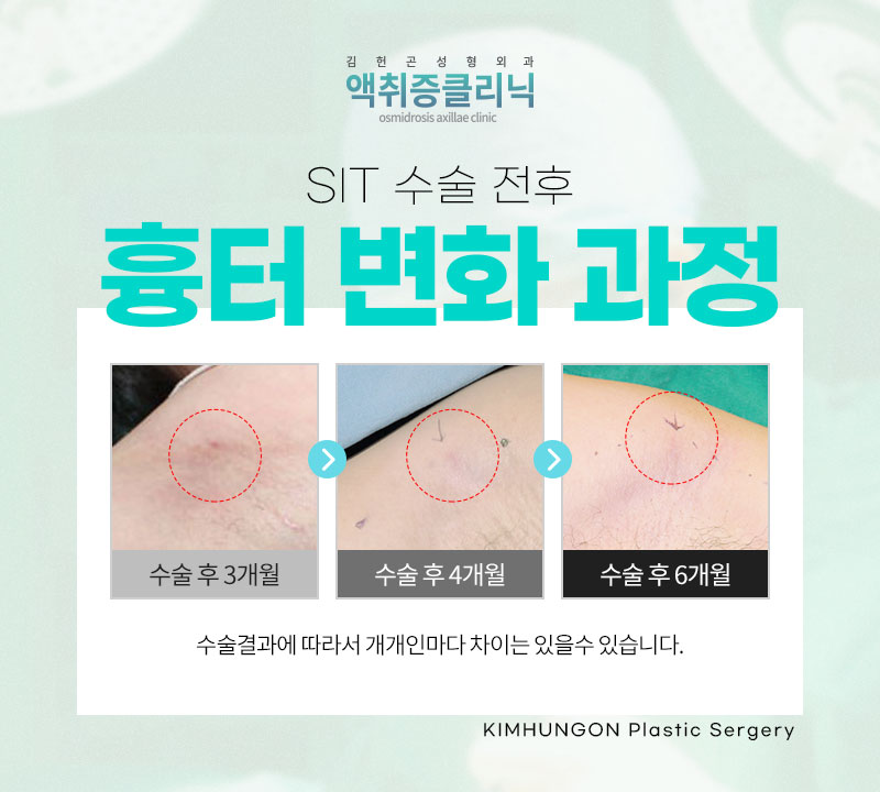 겨드랑이액취증 겨울철 한파에도 사라지지 않는 이유와 SIT수술 방법 관련 이미지 9