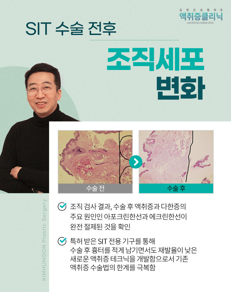 겨드랑이액취증 겨울철 한파에도 사라지지 않는 이유와 SIT수술 방법 관련 이미지 8