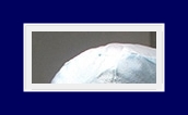 If Underarm Sweat Odor Treatment for Hyperhidrosis or Bromhidrosis Is Severe, Start Treatment Now image 13