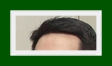 Treatment Methods That Patients With Hyperhidrosis and Excessive Sweaty Hands and Feet Should Pay Attention To image 20