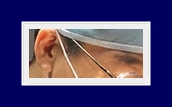 If Underarm Sweat Odor Treatment for Hyperhidrosis or Bromhidrosis Is Severe, Start Treatment Now image 23