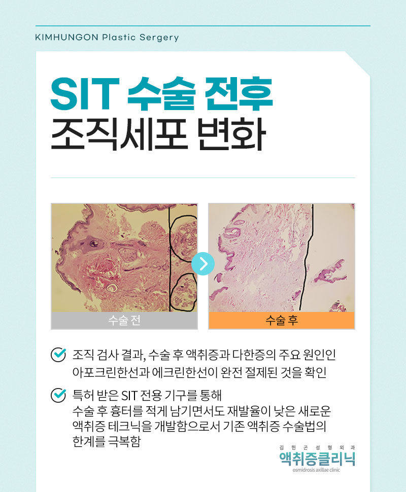 암내제거방법 액취증 치료법 중 재발률 낮은 SIT수술 원리와 장점 관련 이미지 6