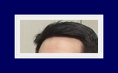 What Are the Treatment Options for Hyperhidrosis? Treatment with SIT Surgery image 17