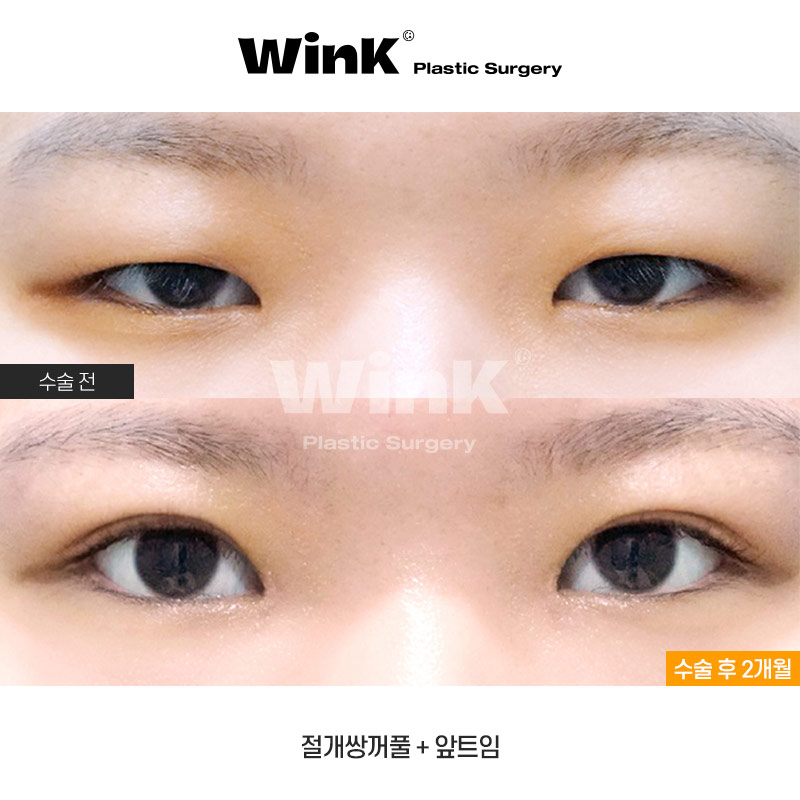 Is Fast Recovery Only Possible with Non-Incisional Surgery? At Wink Plastic Surgery, Incisional Double Eyelid Surgery Can Also Return You to Daily Life Quickly! image 1