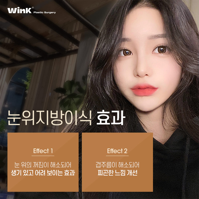 꺼진 눈, 겹주름에는 윙크성형외과 눈위지방이식으로 생기 있게! 관련 이미지 6