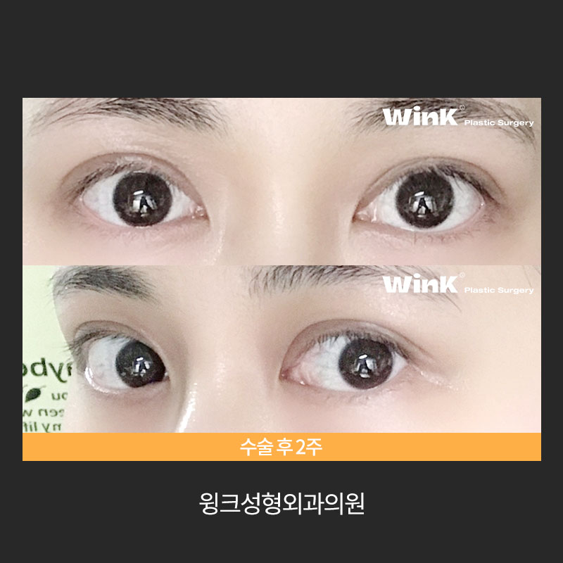 Let’s Learn About Revision Surgery for Severe Eyes? image 7