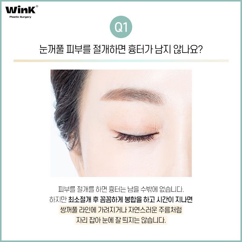 윙크성형외과에서 알려드리는 상안검에 대한 모든 것! 관련 이미지 2