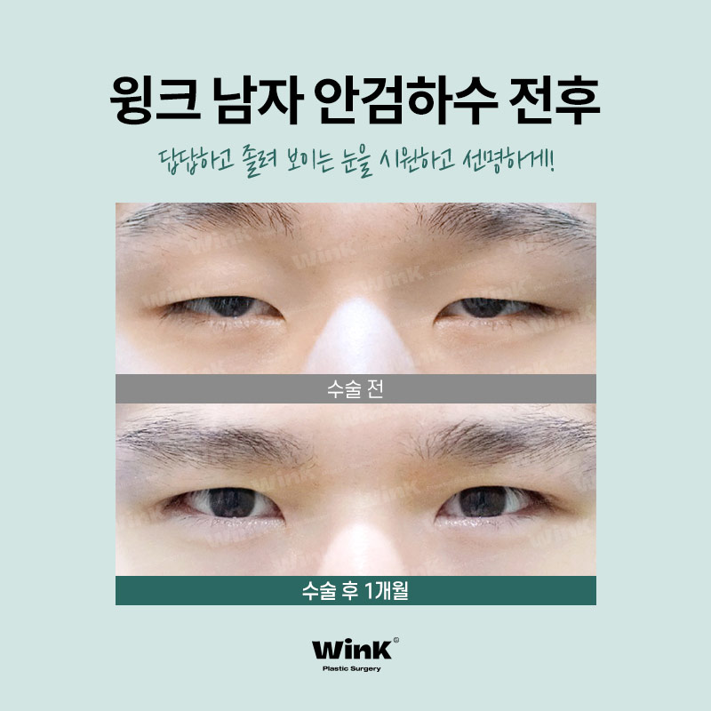 남자안검하수후기 안검하수교정 윙크성형외과 남자눈매교정수술전후 관련 이미지 8
