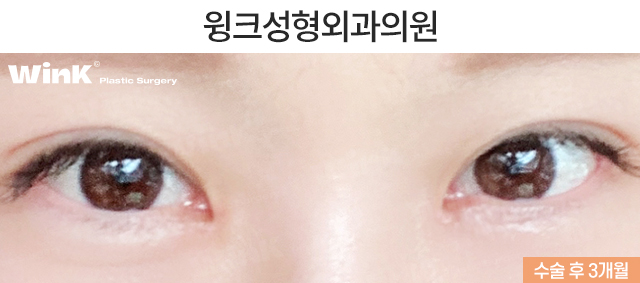 Can Medial Epicanthoplasty Revision and Incisional Double Eyelid Revision Be Done at the Same Time? image 3