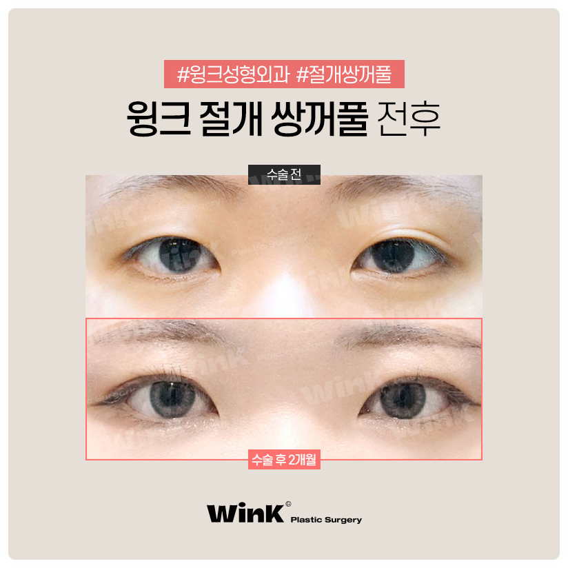 쌍꺼풀수술잘하는곳 쌍꺼풀만들기  신사쌍꺼풀수술 은 윙크성형외과 관련 이미지 6