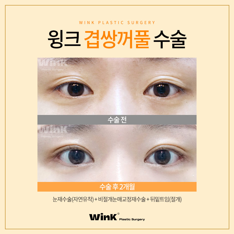 Can Double-Eyelid Surgery Be Done for Double-Fold Eyelids? Wink Plastic Surgery Explains! image 6