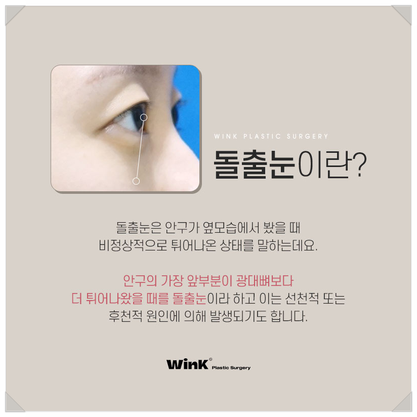 Post-Op Review of Protruding Eyes Surgery, Sunken Eye Fat Grafting, Wink Plastic Surgery Upper Eyelid Fat Repositioning Price, Protruding Eye Fat Grafting image 2