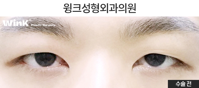 남자 자연유착 쌍꺼풀에 관해 알아볼까요? 관련 이미지 2