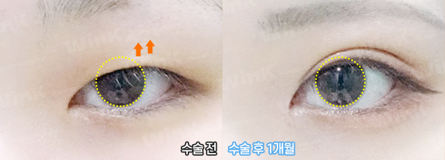 The Key to Ptosis Correction Is Proper Iris Exposure! image 8