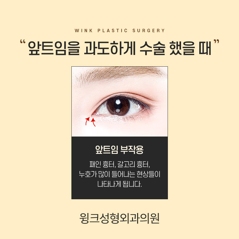 앞트임 복원 한달차 후기 관련 이미지 4