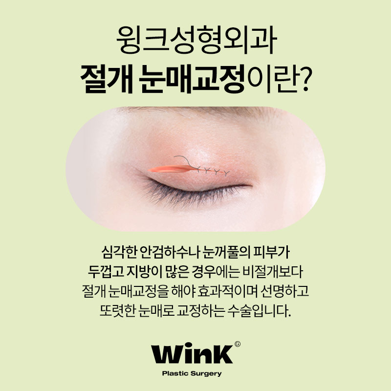 티나지 않는 또렷한 눈을 원한다면? 윙크 눈매교정 관련 이미지 5