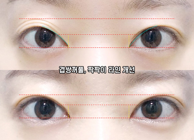 윙크성형외과에서 알려드리는 적절한 눈재수술 시기 관련 이미지 5