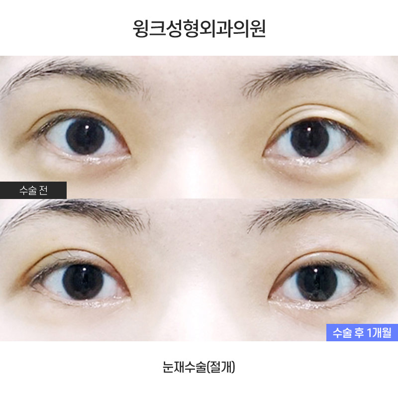 겹쌍꺼풀 해결 방법에 대해 알아보겠습니다. 관련 이미지 1
