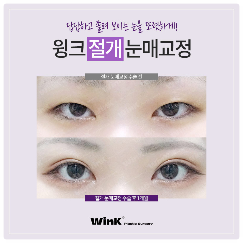 If you are looking into ptosis correction and double eyelid surgery before and after ptosis correction surgery at Sinsa Station, Wink Plastic Surgery image 7
