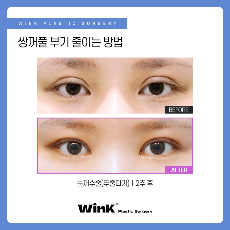 신사역쌍꺼풀수술 후 부기 빨리 빼고 싶다면? 눈수술후관리법 관련 이미지 5