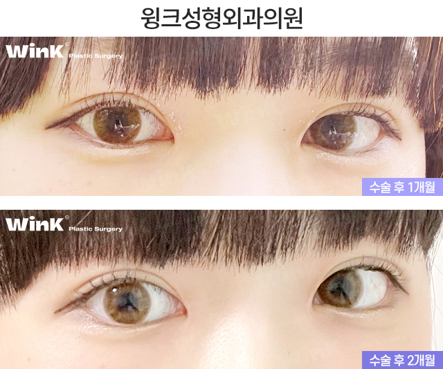 Let’s Take a Look at the Changes and Effects Before and After Upper Epicanthoplasty image 9
